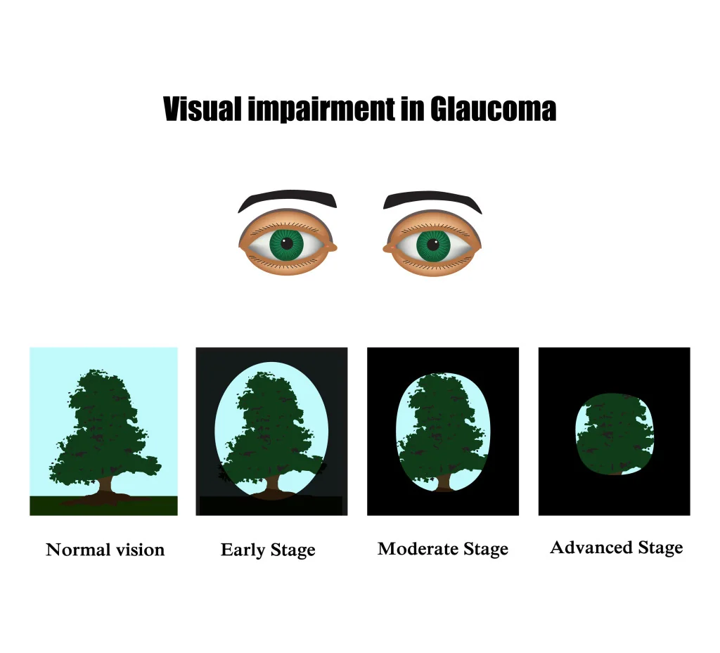 Visual Impairment in glaucoma diagram