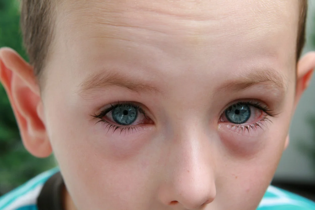 Child with red allergy eyes